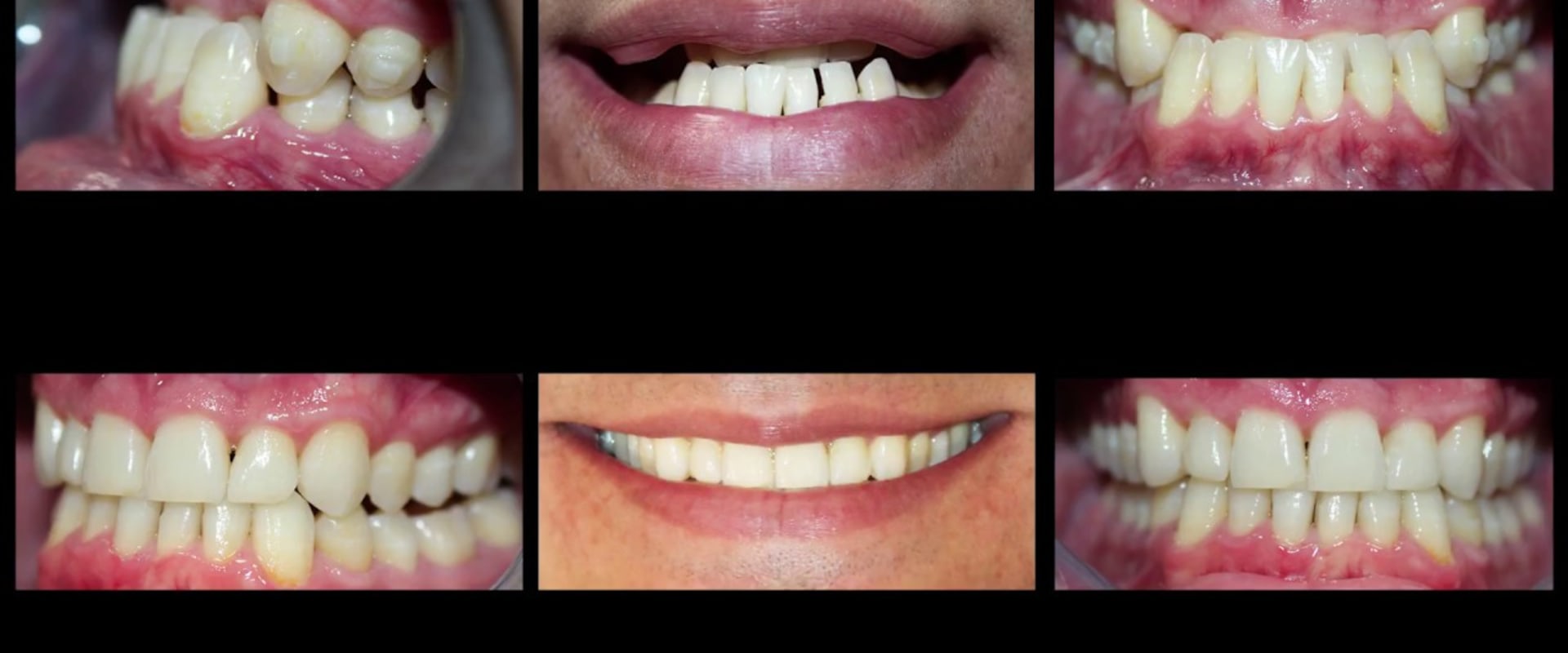 Does Invisalign Include Teeth Reshaping? - A Comprehensive Guide