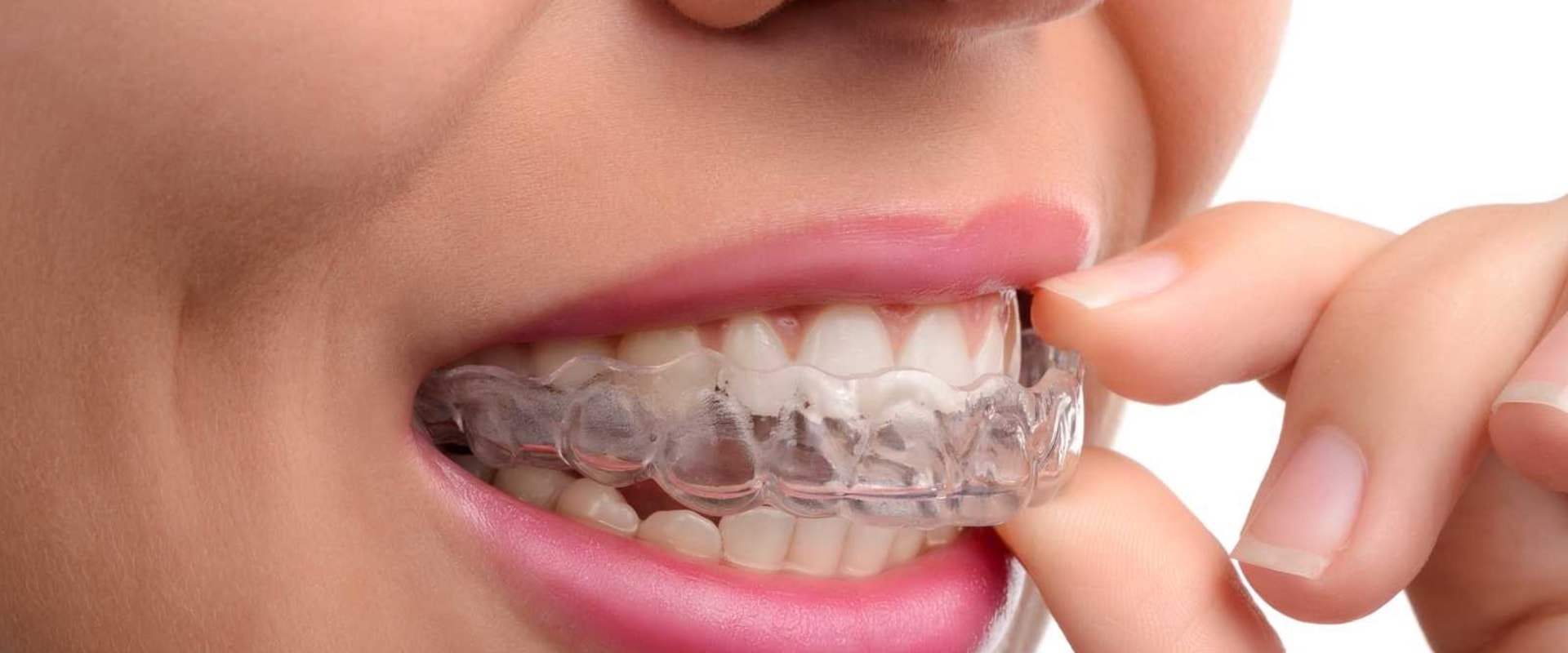 Can I Eat and Drink While Wearing My Invisalign Aligners?
